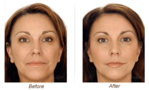 Before / After Microdermabrasion