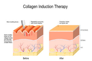 Collagen Induction Therapy Diagram
