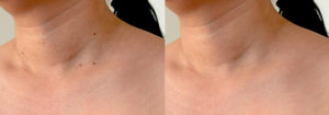 Skin Tag Thermoclear Before & After